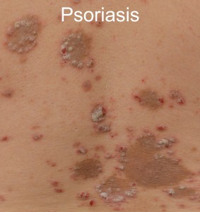 Psoriasis and Other Autoimmune Diseases: Are You at Risk pics Psoriasis and Other Autoimmune Diseases: Are You at Risk images