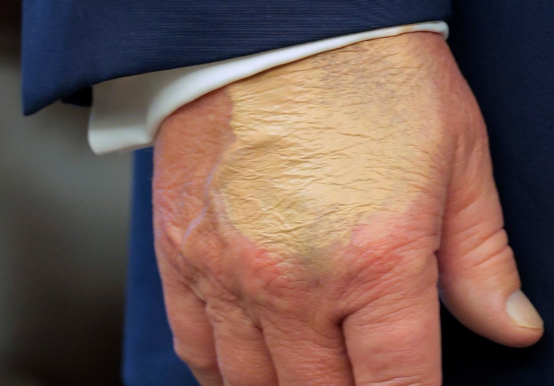 Donald Trump's Health