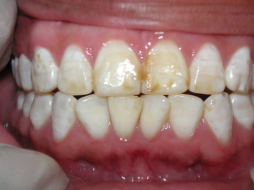 nourishingourchildren.files.wordpress.com_2012_03_dental_fluorosis.jpg