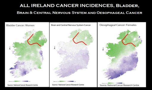 Ireland Cancers Bladder:Brain.jpg Ireland Cancers Bladder:Brain.jpg