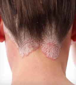 symptoms-of-psoriasis-in-wo.jpg