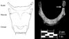 fracture-epstein-1.jpg