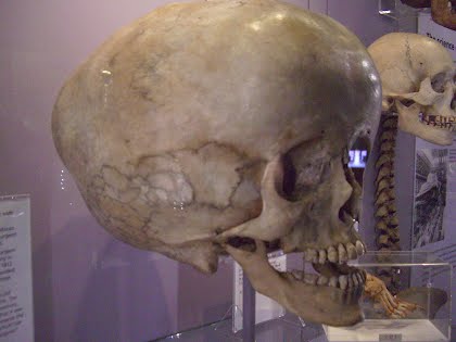 uprightdoctor.files.wordpress.com_2012_08_hydrocephalus_skull.jpg